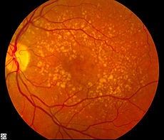 -Leading cause of blindness over age 60
-Progressive disease of retina wherein light-sensing cells in central area of vision (macula) stop working and eventually die
-Loss of detail vision, contrast sensitivity, relative/absolute scotoma
-Two types: 

