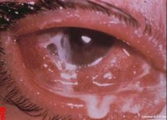 -Present: acute onset swollen eye, copious drainage
-Rapid onset of purulent drainage
-Tx w/ antibiotics such as topical fluoroquinolone or IM Ancef and poazithromycin