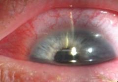-Present: eye pain, photophobia after bumping eye
-Ciliary flush, pupil asymmerty, pain, photophobia after trauma
-Tx w/ topical corticosteroic