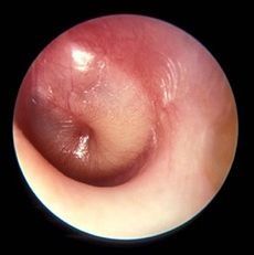 -Bacterial infection of the mucosally lined air-containing spaces of the temporal bone
-Usually precipitated by a viral URI that causes eustachian tube obstruction, resulting in accumulation of fluid and mucus, which become secondarily infected by bacter