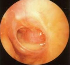 -Chronic infection of middle ear and mastoid as a consequence of recurrent acute otitis media
-Bacteriology: P aeruginosa, Proteus species, mixed anaerobes
-Purulent d/c with or without otalgia
-TM perforation with conductive hearing loss
-Tx w/ debri