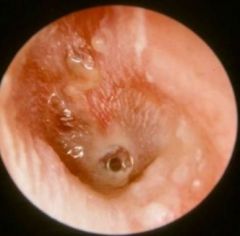 -Infection of inner ear in children w/ BMT tubes
-Risk factors include URI, EAC contamination, retained tubes
-Bacteriology: S aureus, P aeruginosa, a-hemolytic strep
-Sx include purulent otorrhea (no pus = no infection)
-Tx w/ ototopical antibiotics 