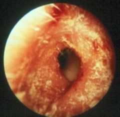 -Inflammation of EAC
-Often hx of recent water exposure ("swimmer's ear") or mechanical trauma (eg, scratching, cotton applicators)
-Bacteriology: staph,  gram-negative rods (eg, Pseudomonas, Proteus) or fungi (eg, Aspergillus), which grow in the presen