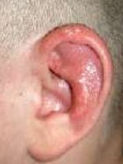 -Shingles of the ear
-If associated w/ facial nerve paralysis called Ramsey Hunt Syndrome
-Tx w/ antivirals or corticosteroids