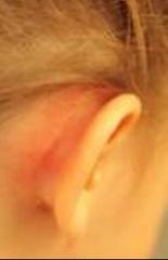 -Postauricular pain, fever and outwardly displaced pinna
-Mastoid often appears swollen and red
-Consequence of middle ear infection
-Tx w/ myringotomy and IV antibiotics