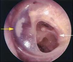 -Small holes in TM membrane
-Caused by direct trauma, infection, loud noise, flying, diving
-Never irrigate and avoid swimming and getting water in ears