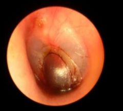 -Painful hemorrhagic vesicles on TM, canal, or both
-Associated earache, blood tinged d/c, and conductive hearing loss
-Caused by mycobacterium pneumonia
-Tx is primarily pain control