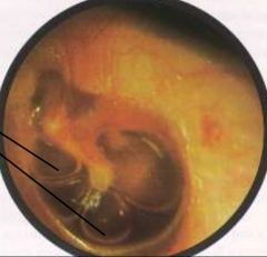 -Air bubbles in middle ear w/ or w/o hearing impairment, pain
-Caused by Eustachian tube dysfunction, resolving bacterial OM, allergies, large adenoids
-Tx w/ antibiotics, antihistamines, decongestants