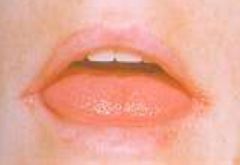 -Deep fissures at corners of mouth
-Can be seen w/ poorly fitting dentures, lip licking, rarely Riboflavin deficiency