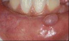 -Painless, thin sac on the inner surface of the lips containing clear fluid
-Caused by traumatic rupture of mucous gland
-Tx w/ laser ablation or total excision