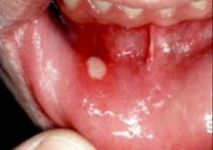 -AKA canker sore 
-Most common oral mucosa lesion
-Shallow, recurrent white, round or oval ulcerative lesion w/ red halo and pseudomembrane
-Tx w/ tetracycline rinse, kenalog, lidocaine, zine lozenges