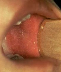 -White specks w/ redbase opposite 1st/2nd molars
-Associated w/ measles (ribeola)
