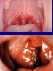 -Abrupt onset of sore throat, fever, malaise, nausea, and headache
-Throat red and edematous, with or without exudate; cervical nodes tender
-Caused by group A beta-hemolytic strep
-Tx w/ penicillin, macrolide, cephalosporin