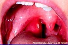 -Infection of tissue between tonsils and pharynx
-Trismus and "hot potato" voice
-Red swollen tonsils, tonsillar pillars and soft tissue adjacent to soft palate
-Tx w/ I&D or tonsillectomy