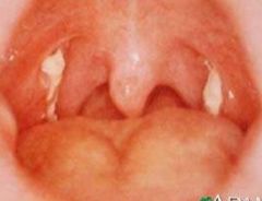 -Fever, sore throat, exudative pharyngitis, uvular edema, tonsillitis, or gingivitis may occur and soft palatal petechiae may be noted
-Caused by EBV
-Tx is symptomatic