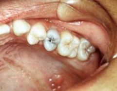 -Discoloration or erosion of crown or base of teeth
-Often painful to percussion
