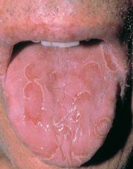 -Scattered smooth red areas that are denuded papillae
-Condition is benign