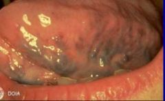 -Usually seen on ventral surface of tongue
-Blanche w/ pressure