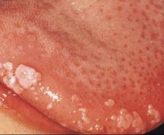 -Oral lesion (wart) on tongue
-HPV virus