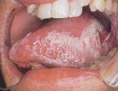 -Corrugated or hairy raised nonpainful white lesions on lateral sides of tongue
-Associated w/ EBV