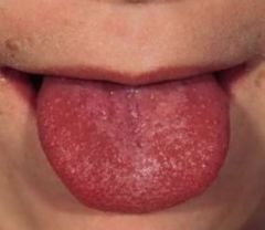 -Enlarged red papillae on tongue
-Associated w/ Scarlet fever