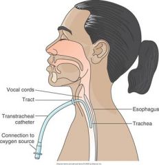 TRANSTRACHEAL OXYGEN THERAPY
Transtracheal oxygen (TTO) is a long-term method of deliv­ering oxygen directly into the lungs. The physician passes a small, flexible catheter into the trachea via a small incision with the use of local anesthesia. TTO allow