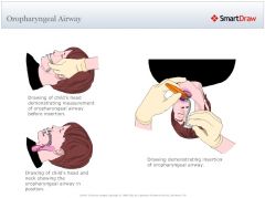 Inserting an Oropharyngeal AIrway