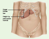 Downward displaced liver


 


It is likely a low diaphragm, the upper border is also low (due to the low diaphragm) so the bottom liver edge is past the costal margin, common in COPD.