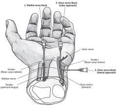 A. can be blocked at the elbow immediately medial to the brachial artery


B. No. Median nerve between palmaris longus and flexor carpi radialis.
C. No. This is ulnar nerve.
D. Formed from lateral and medial cords
E. No. Radial

Median nerve betw...