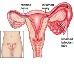 Acute inflammation of upper reproductive tract.
  -Salpingitis: Inflammation of the fallopian tubes
  -Oophoritis: Inflamation of the ovaries

-STIs migrate from the vagina to the upper genital tract (gonorrhea and chlamydia).