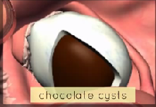 endometrioma or chocolate cyst- when blood accumulates under the ovarian capsule