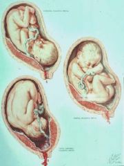 Placenta forms on the lower uterine segment