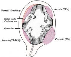 The placenta forms too deeply into the uterus wall