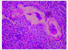 -34 year old woman from Saudi Arabia
-Mild eosinophilia (AEC 500) at time of dx with B cell lymphoma
-4 months after chemo - diffuse abdominal pain, bloating, constipation, occasional rectal bleeding
-Eosinophils increased to 1000
-Lymphoma cl...