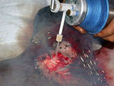Cryosurgery using liquid nitrogen. Involves two freeze-thaw cycles