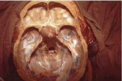 What is this? What are the two small tan structures on either side of the tumor? 
 
How could you get to a pituitary adenoma surgically without removing the top of the skull and the brain? 
How do you take this thing out?