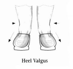 rearfoot is deviated toward the outside resulting in pronated heel
