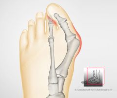 the first metatarsal has an abduction deformity ("bunion")