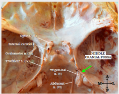 The internal carotid is directly inferior to the Optic n. (CN II).