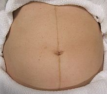 hyperpigmentation of the abdominal midline during pregnancy
