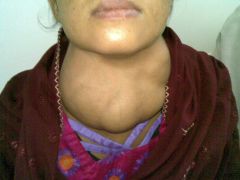 Enlargement of thyroid with multiple nodules 

Due to decrease iodine 

Usually nontoxic (euthyroid - "normal" thyroid)

Rarely, toxic goiter