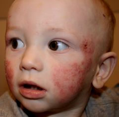 4 year old pt. presents with chronic allergic rhinitis and a rash which itches on his face.  What does this kiddo probably have?