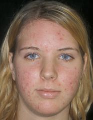 16 yr old female pt. presents with some red spots on her face.  She has been having them for 2 years now and she is confused as to what it is.  What do you tell her the reason for this skin issue?