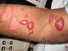 24 yr old male pt. comes in with lesions on his forearm.  When you touch them they don't rupture easily.  What does he likely have?