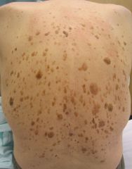 sudden onset of multiple seborrheic keratoses and suggests underlying carcinoma of the GI tract

Paraneoplastic syndrome