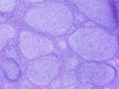 Neoplastic proliferation of small B-Cells (CD20+)  that form follicle-like nodules

 (lots of follicles - little circle things)