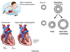 a.	Diastolic Dysfunction
b.	Concentric hypertrophy
c.	Causes: familial, AD
d.	The septum hypertrophies and blocks mitral leaflets obstructing outflow → systolic murmur & syncope
e.	Findings: normal sized heart, S4, systolic murmur 
f.	Think young ath