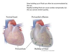 a.	The pericardial space normally has 30-50mL of thin, clear and straw colored pericardial fluid. 
b.	Under various circumstances the parietal pericardium may be distended by serous fluid = pericardial effusion.  (blood = hemopericardium, or pus = purule