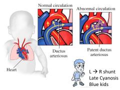 a.	Causes a R→L shunting of blood in utero
b.	After birth lung pressures are low and shunt becomes L → R
c.	PDA or Failure of DA to close after birth can lead to RVH and failure. 
d.	Continuous machine like murmur. Uncorrected PDA may eventually result