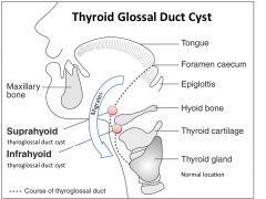 a.	Thyroid arises from the flow of the primitive pharynx and descends to the neck. 
b.	Thyroid is connected to the tongue by the thyroglossal duct. 
c.	Thyroglossal duct normally disappears but may persist as a lobe of the thyroid gland. 
d.	Thyrossal 